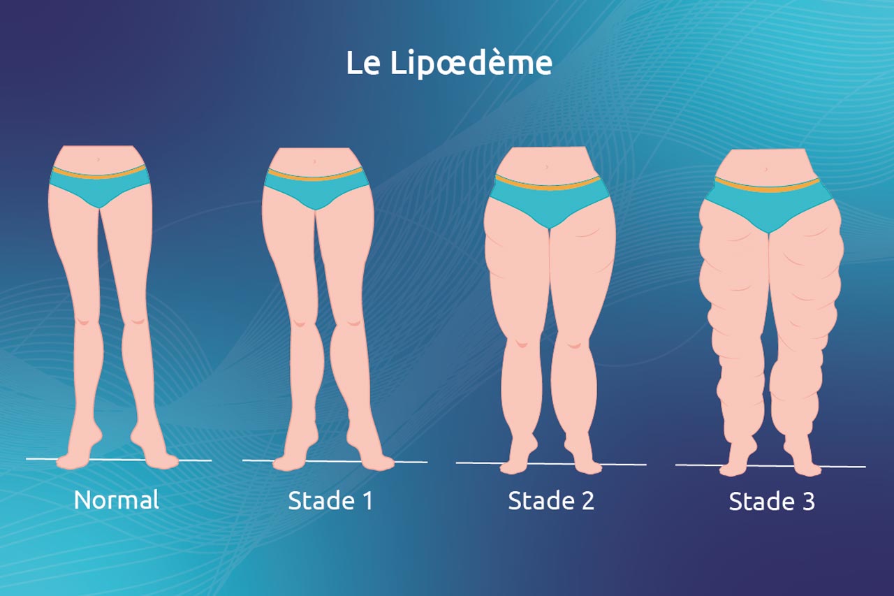 Lipoedème ou simple surpoids : comment faire la différence